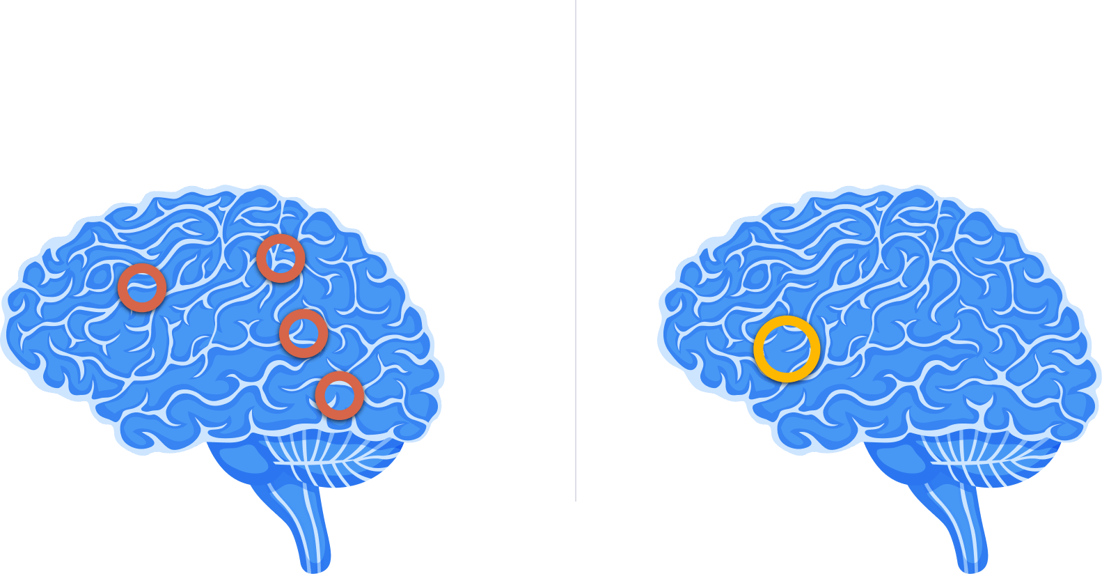Brain comparison: Non-Dyslexic vs Dyslexic